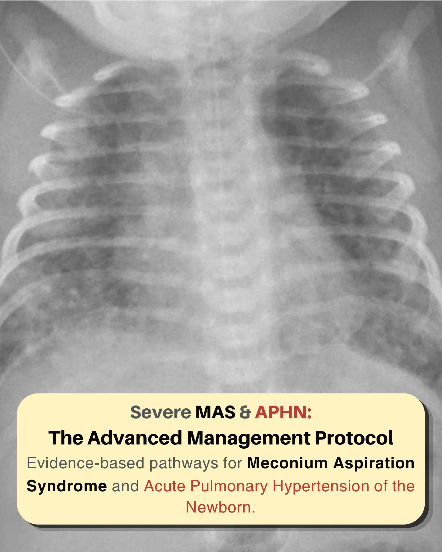 Severe MAS & APHN: The Advanced Management Protocol