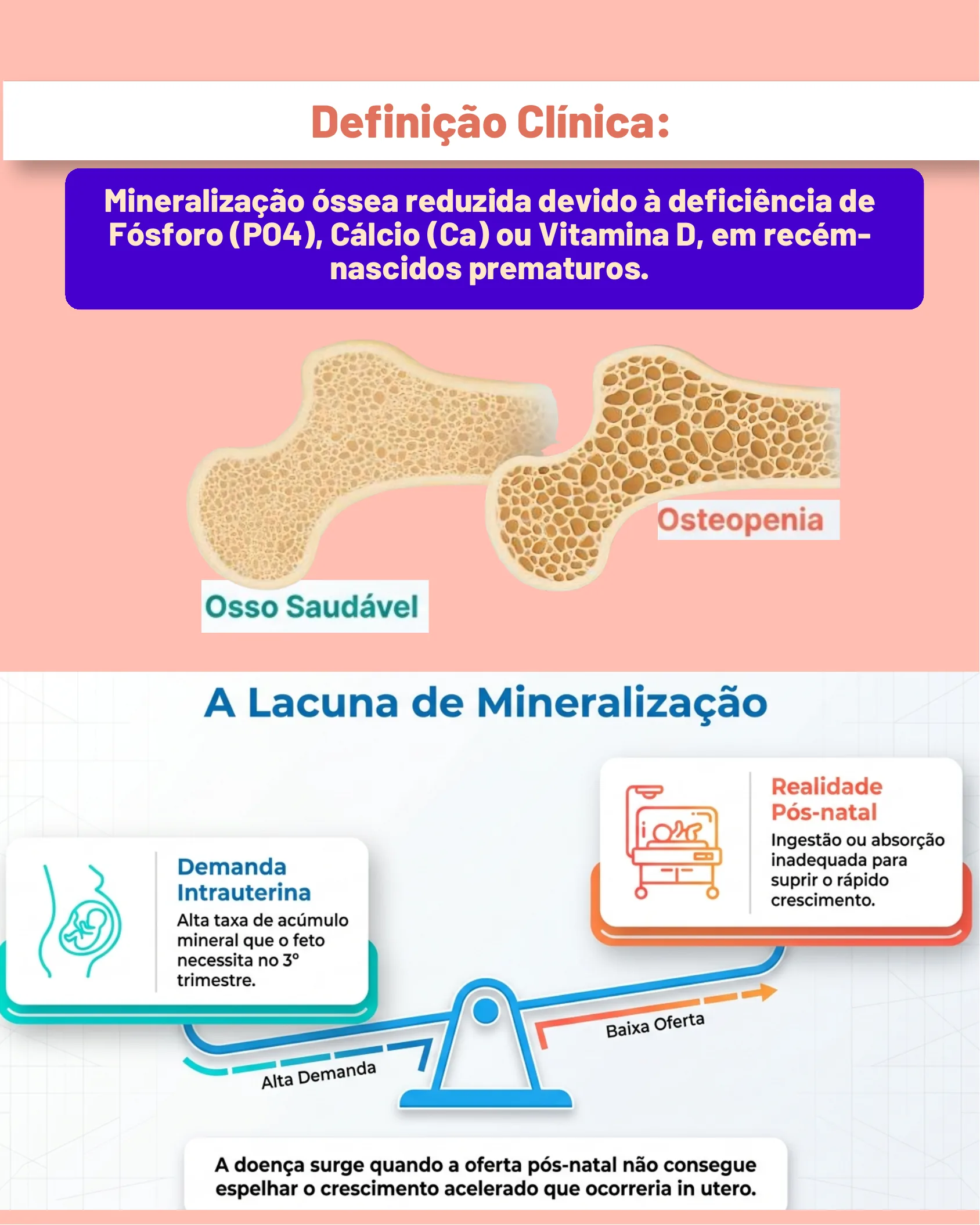 Comparação entre osso saudável e osso com osteopenia, e infográfico explicando o desequilíbrio entre demanda intrauterina e oferta pós-natal de minerais.