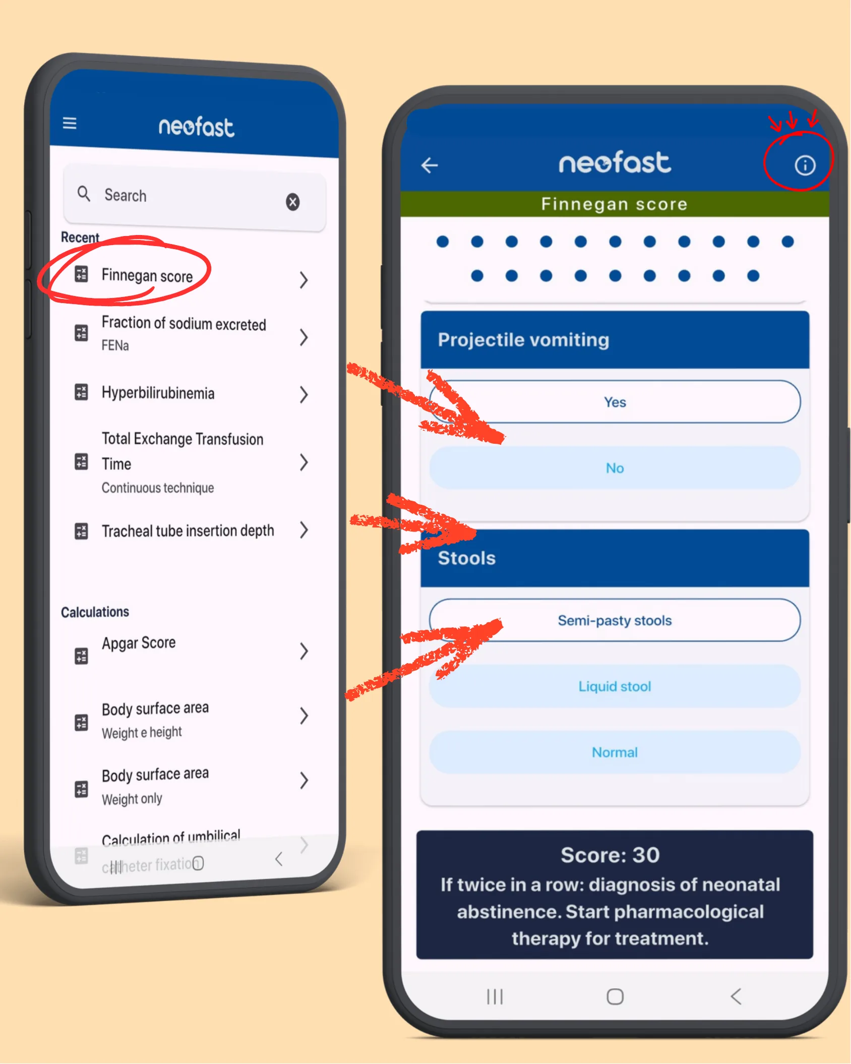 Two smartphone screens showing the neofast app interface for the Finnegan score calculator, with fields for projectile vomiting and stool type, and a resulting score of 30 indicating diagnosis of neonatal abstinence.