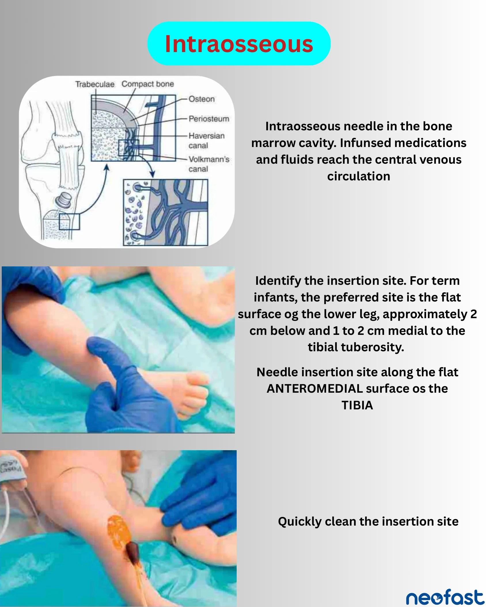 Anatomical diagram of the bone marrow cavity with trabeculae, compact bone, and periosteum, alongside photos demonstrating identification and cleaning of the intraosseous needle insertion site on an infant's leg.