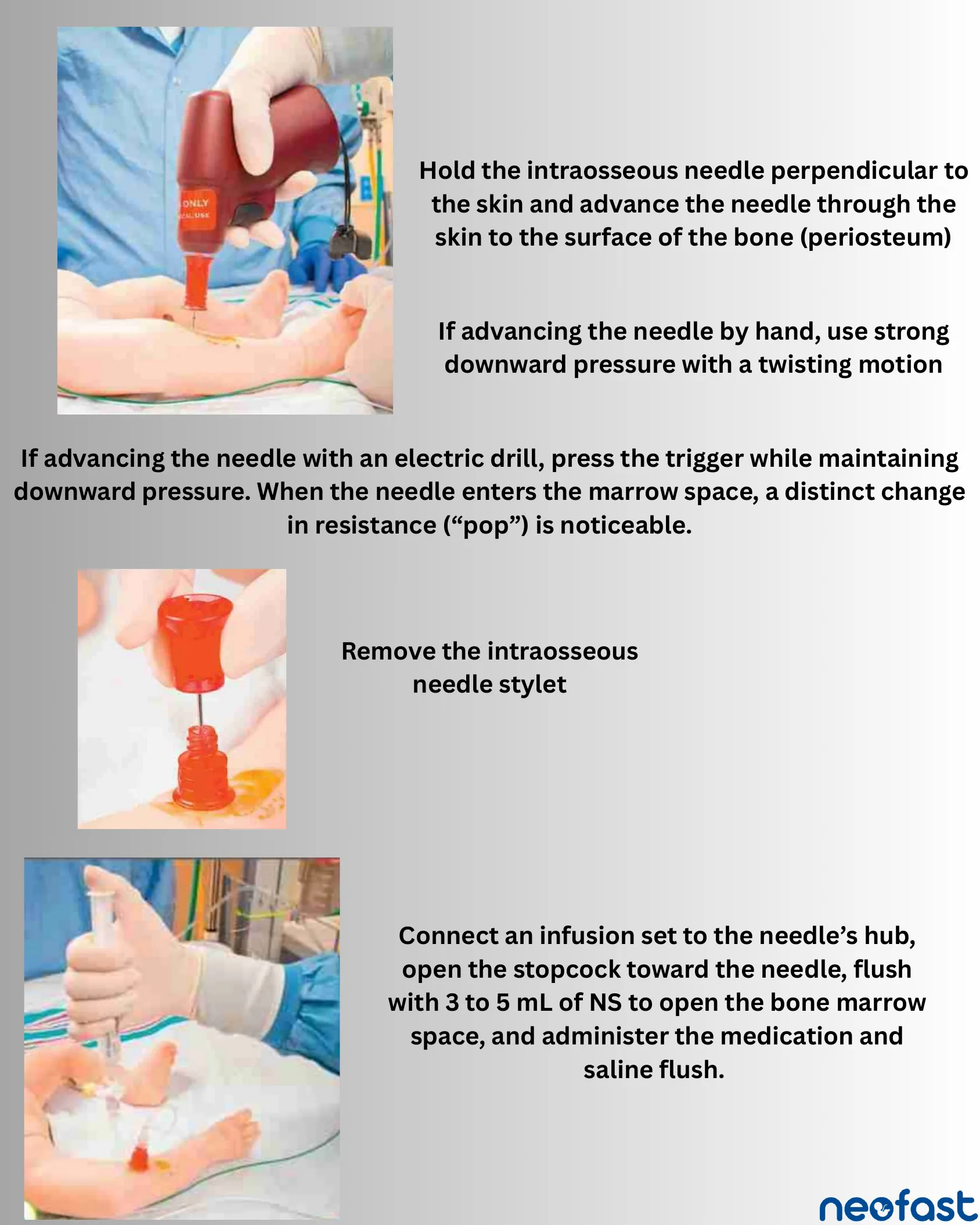 Step-by-step photos of intraosseous needle insertion using a drill, including needle advancement, stylet removal, and connecting an infusion set with saline flush.