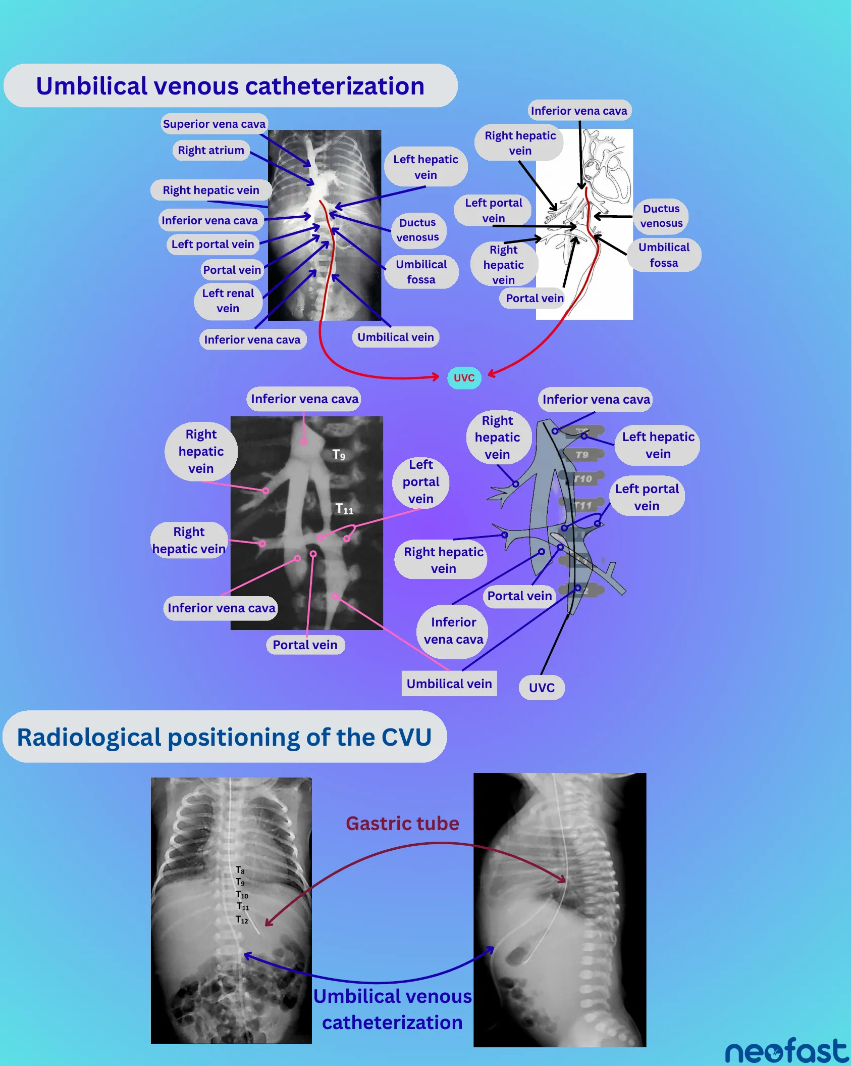 Anatomical diagrams and radiographs illustrating umbilical venous catheterization pathway through hepatic veins, portal vein, and inferior vena cava, with labeled vertebral levels T8-T12.