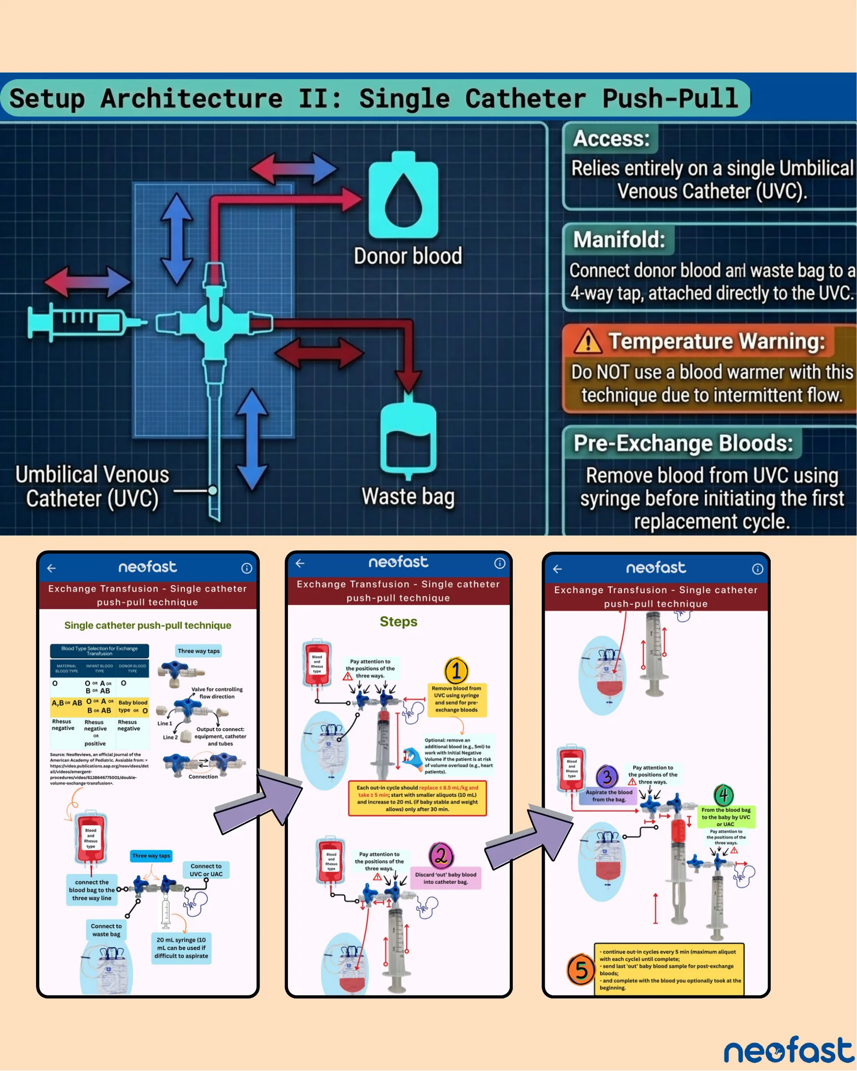 Diagram of the single catheter push-pull exchange transfusion setup using a 4-way tap connected to a UVC, donor blood, syringe, and waste bag, alongside NeoFast app screenshots illustrating the step-by-step push-pull technique.