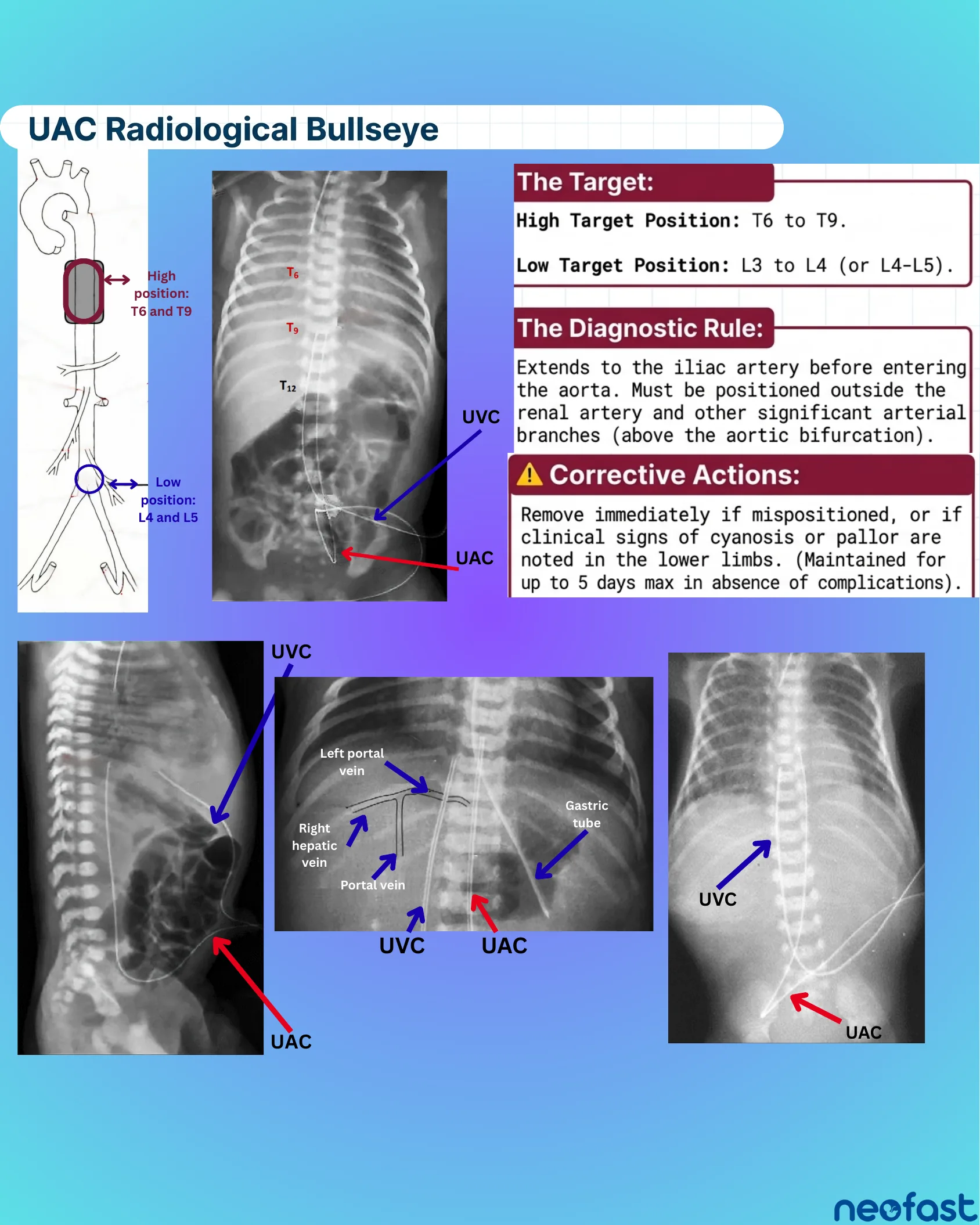 Set of neonatal abdominal radiographs with labeled UVC and UAC catheter positions, alongside target position criteria and corrective action guidance for umbilical arterial catheters.