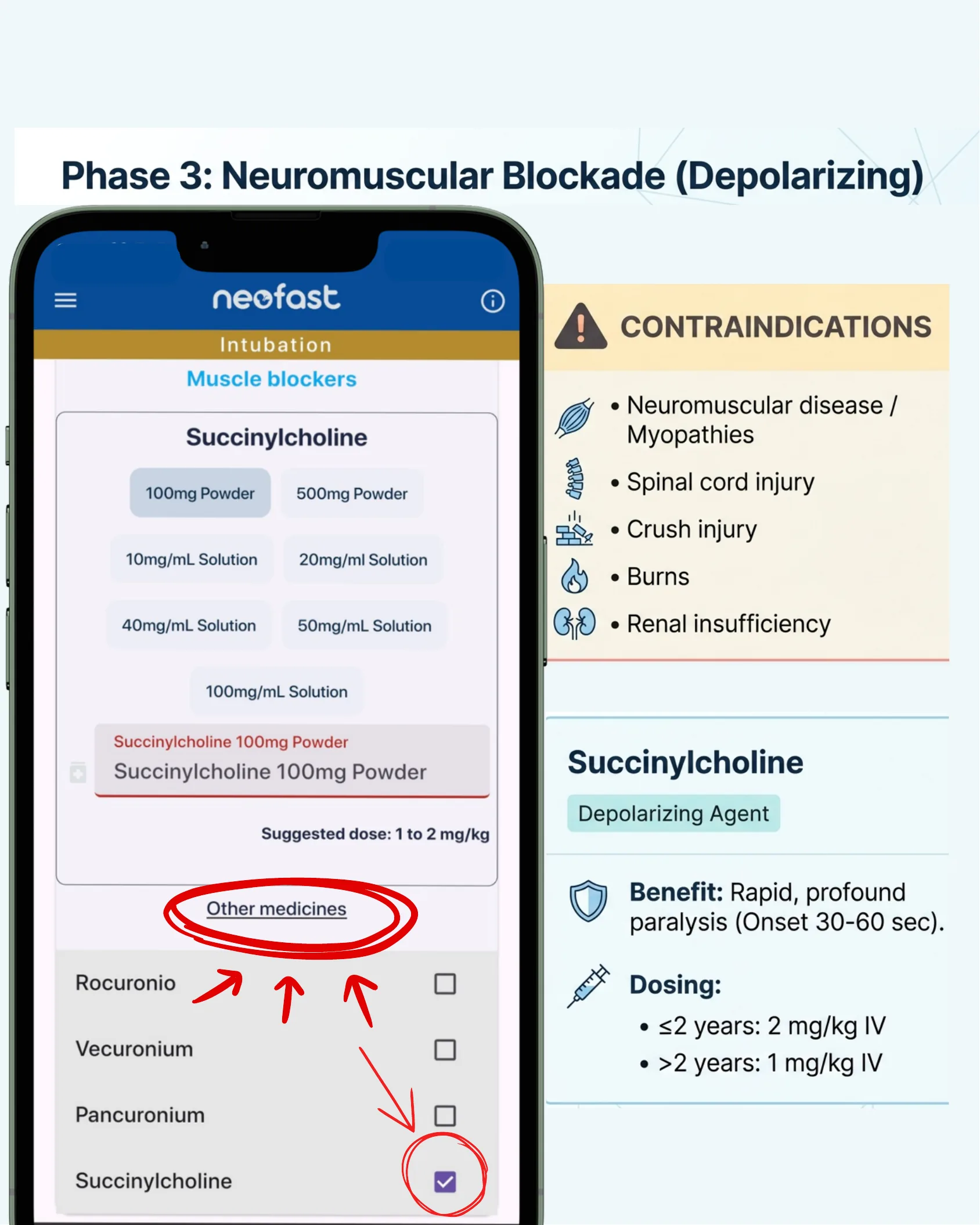 Neofast app screenshot showing Succinylcholine dosing options alongside a contraindications panel for the depolarizing agent.
