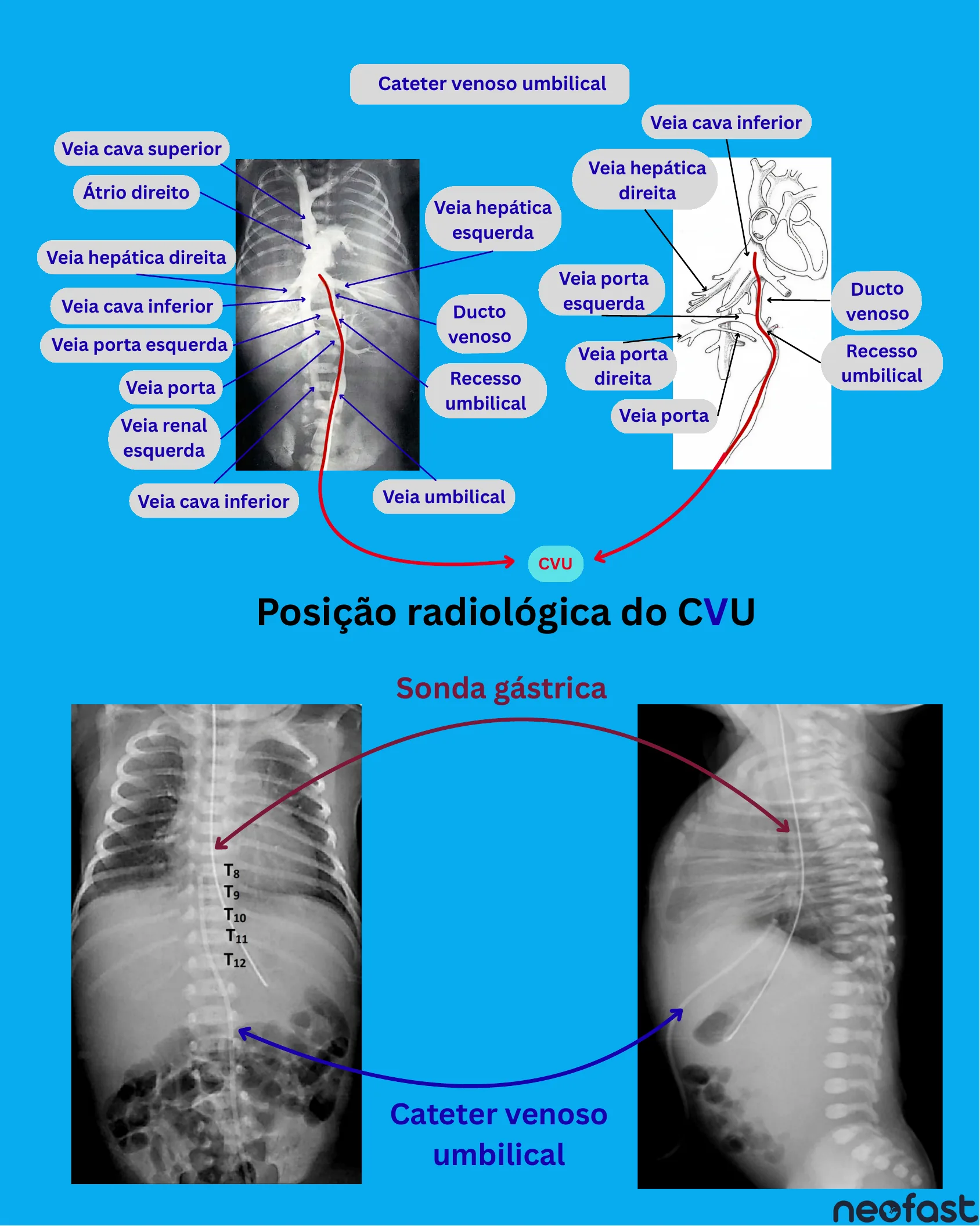 Radiografias em incidência frontal e esquema anatômico mostrando o trajeto do cateter venoso umbilical através da veia umbilical, ducto venoso e veia cava inferior até o átrio direito, além de radiografias de tórax e abdome mostrando a posição do CVU e da sonda gástrica em relação às vértebras T8 a T12.
