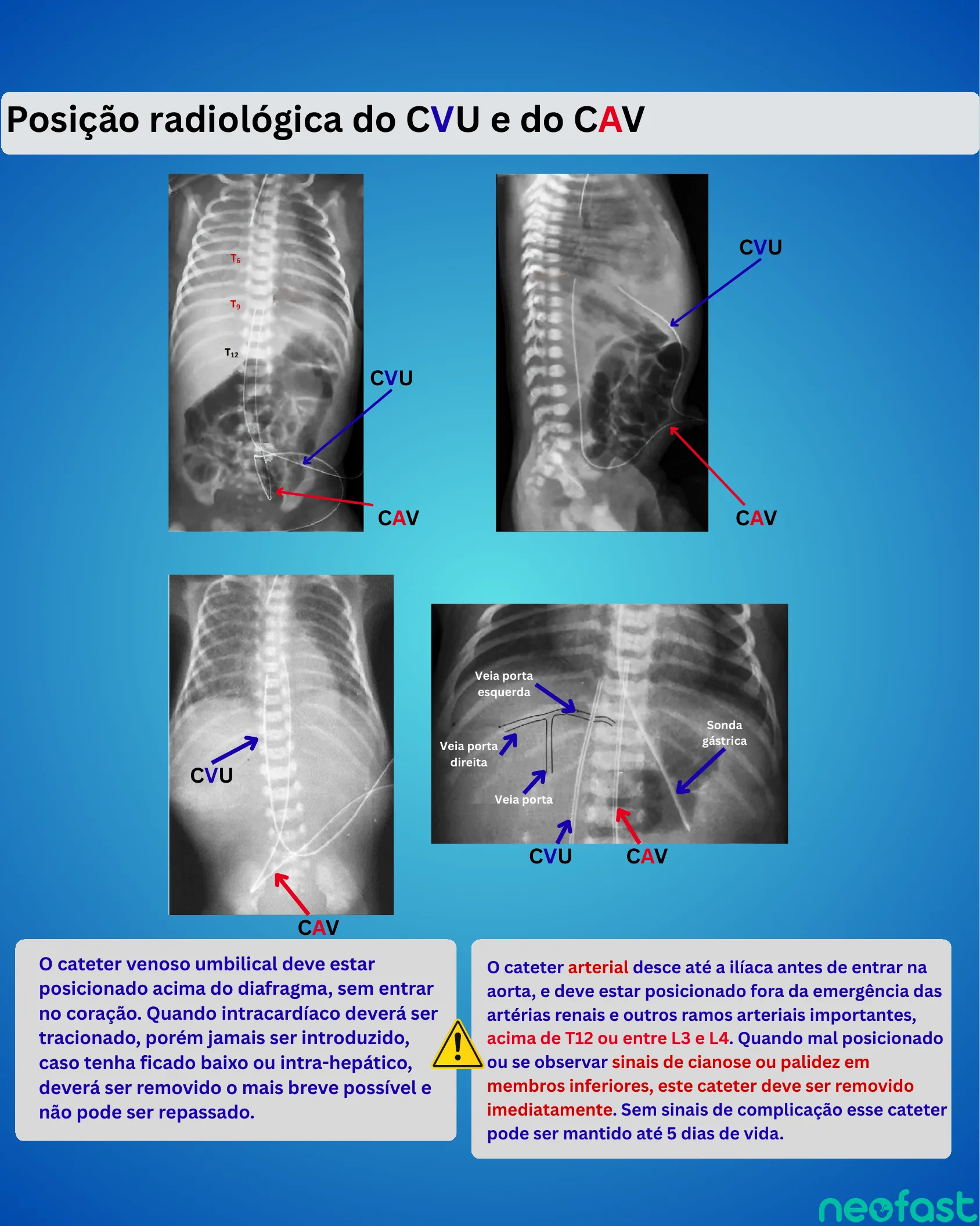 Quatro radiografias (frontal e perfil) demonstrando a posição correta do cateter venoso umbilical (CVU) e do cateter arterial umbilical (CAV), com marcações vertebrais T6, T9 e T12, além de textos explicativos sobre os cuidados e limites de posicionamento de cada cateter.