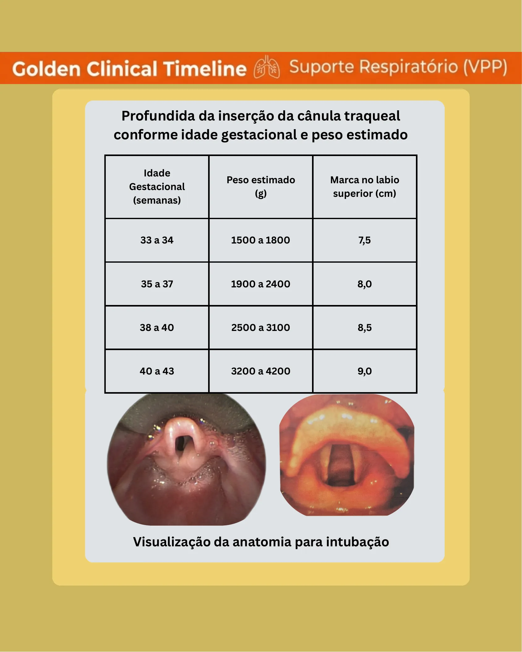 Tabela com a profundidade de inserção da cânula traqueal marcada no lábio superior conforme idade gestacional e peso, acompanhada de fotos endoscópicas da anatomia das vias aéreas.