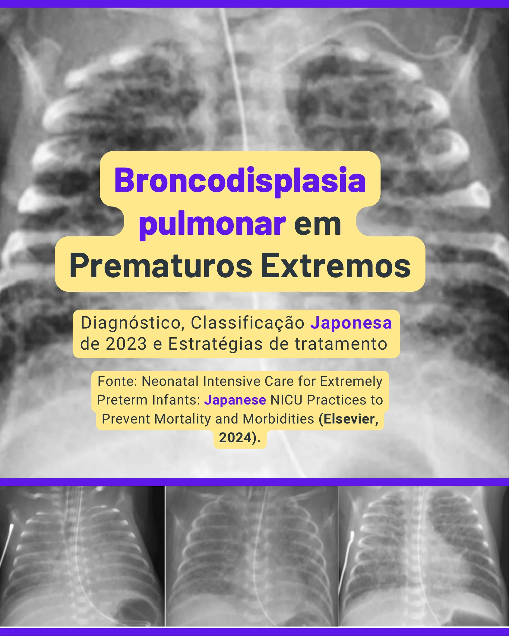 Capa do infográfico sobre broncodisplasia pulmonar em prematuros extremos com radiografias de tórax de fundo.