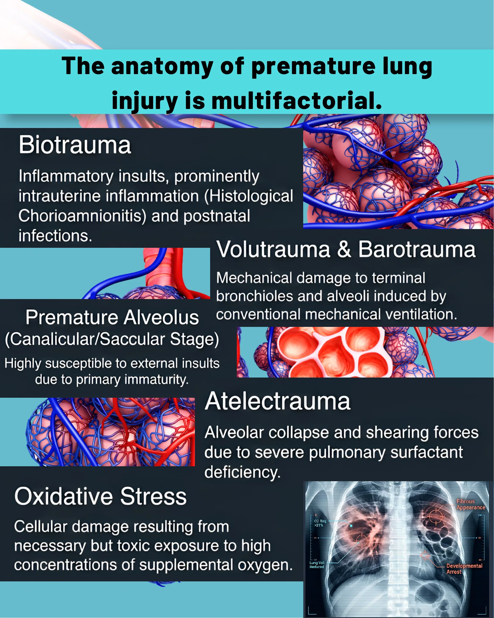 Illustrated diagram of alveoli and blood vessels paired with five text panels describing biotrauma, volutrauma and barotrauma, premature alveolus, atelectrauma, and oxidative stress as causes of lung injury.
