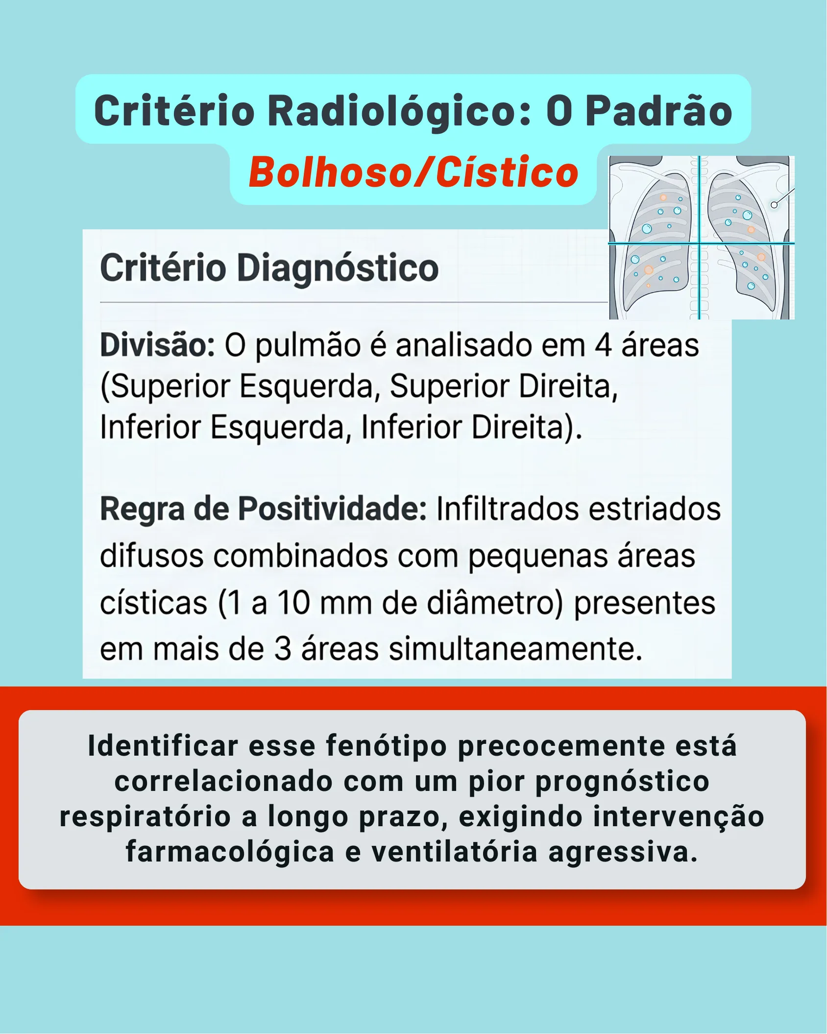 Diagrama de radiografia de tórax dividido em quatro áreas ilustrando o critério diagnóstico do padrão bolhoso/cístico.