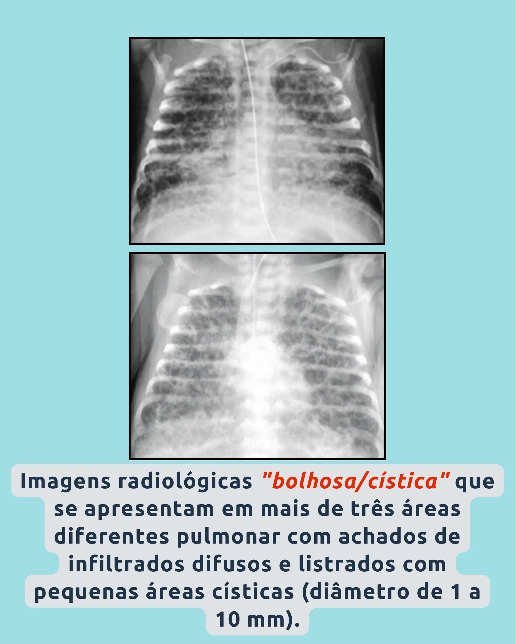 Duas radiografias de tórax de recém-nascidos mostrando padrão bolhoso/cístico com infiltrados difusos e pequenas áreas císticas.