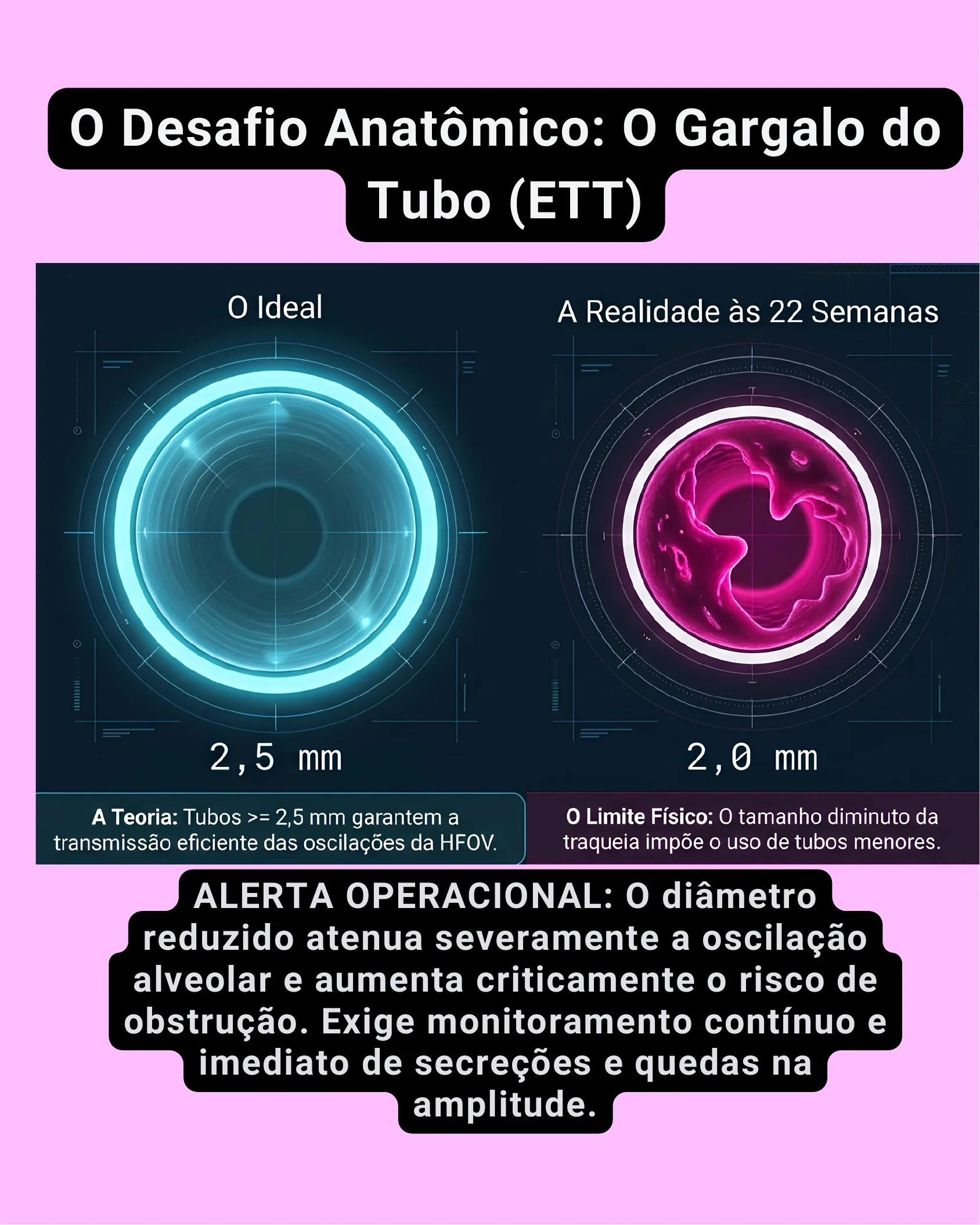 Ilustração comparando um tubo endotraqueal ideal de 2,5 mm com abertura ampla e um tubo real de 2,0 mm com lúmen reduzido e irregular usado em prematuros de 22 semanas.
