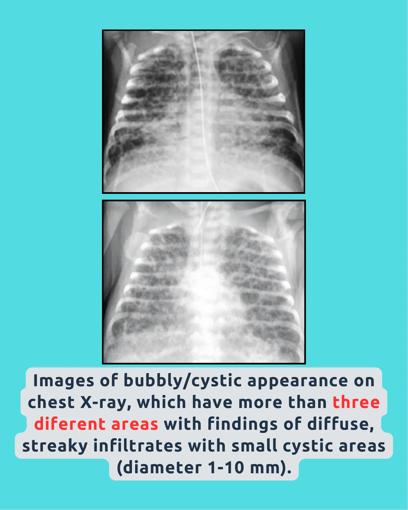 Two neonatal chest X-ray images showing bubbly cystic lung appearance with a caption describing the diagnostic criteria involving more than three lung areas.