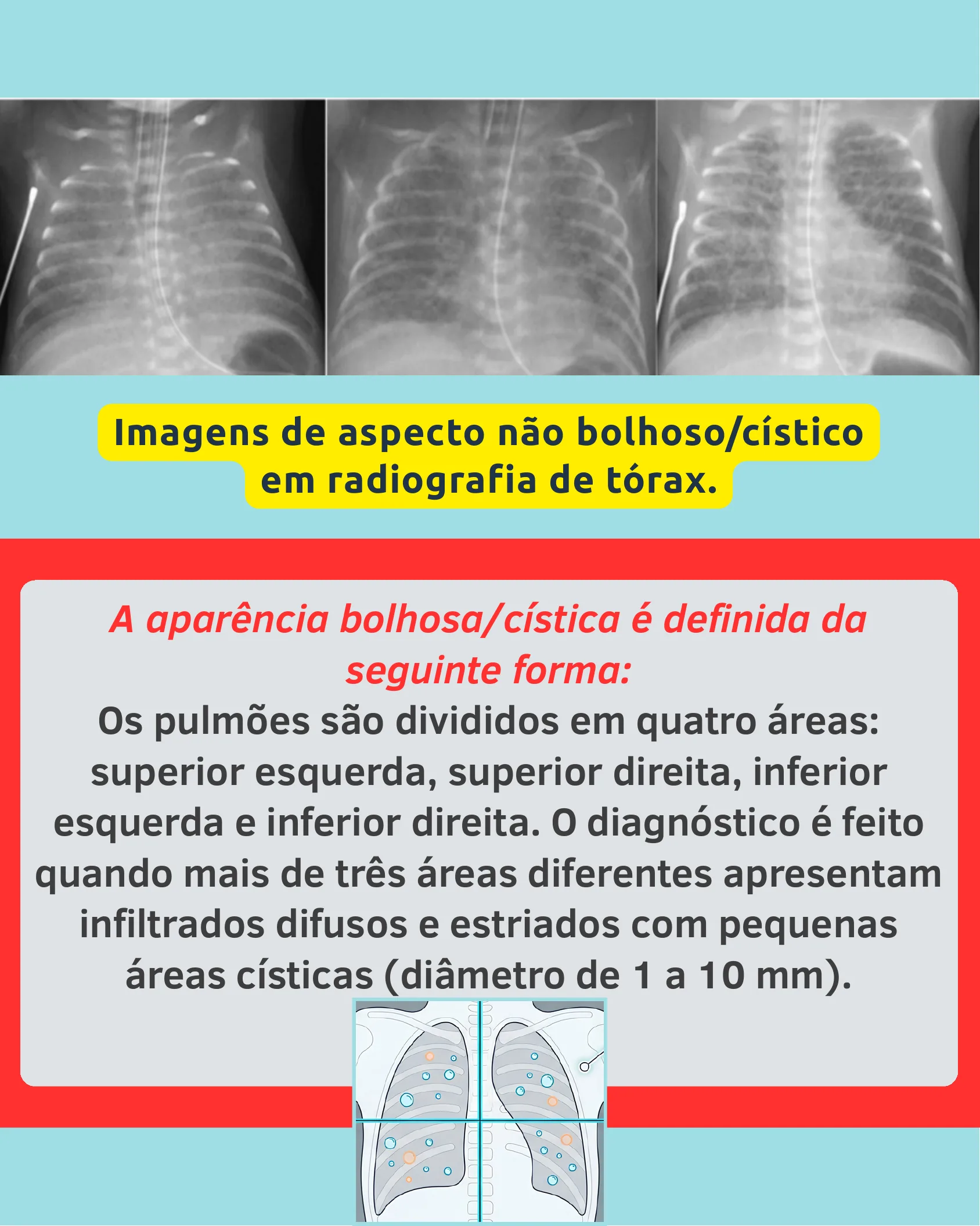 Três radiografias de tórax de recém-nascidos comparando aspecto não bolhoso/cístico, com explicação do critério diagnóstico.