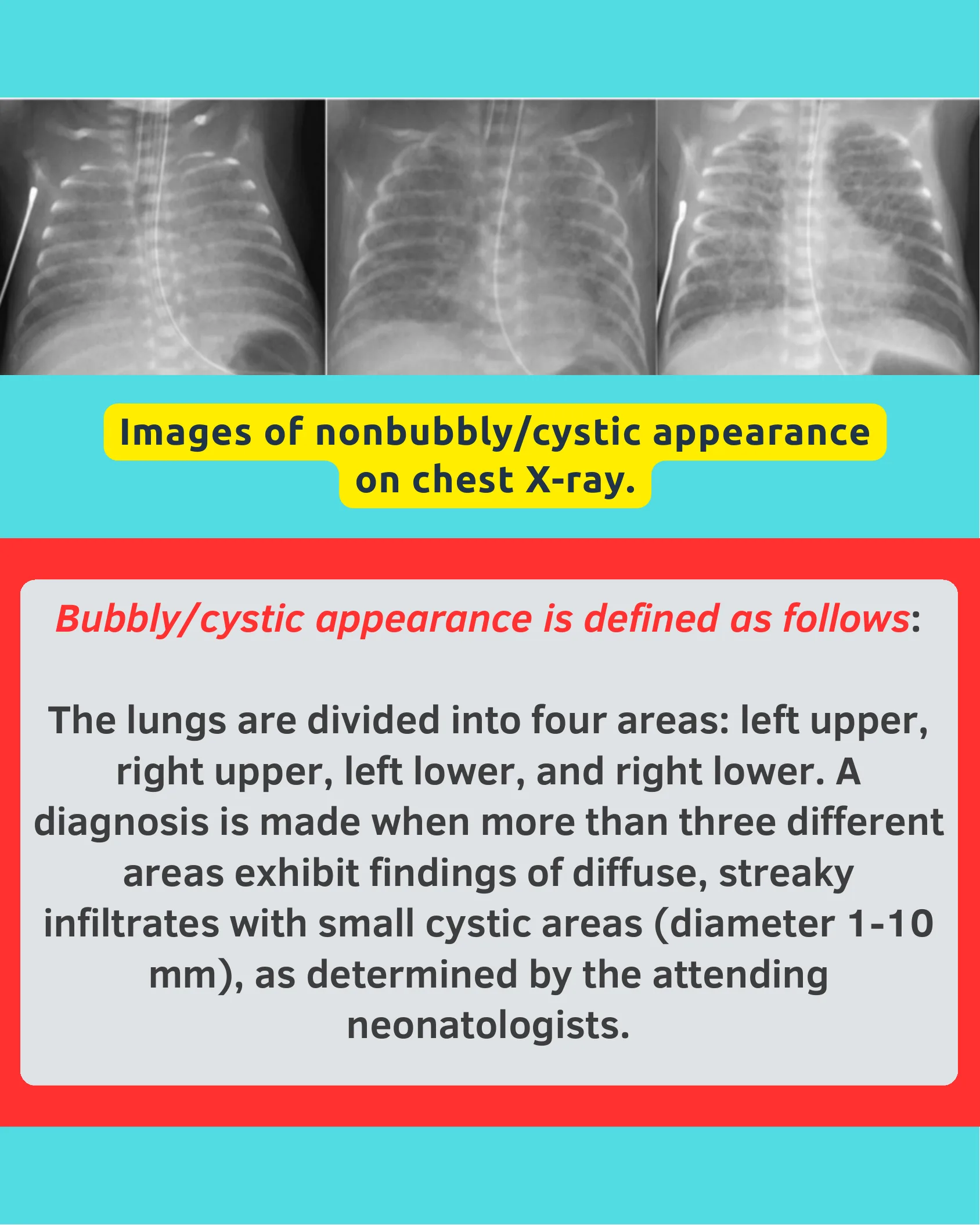 Three neonatal chest X-ray images showing nonbubbly cystic lung appearance, followed by a red-bordered box defining the diagnostic criteria for bubbly cystic appearance.