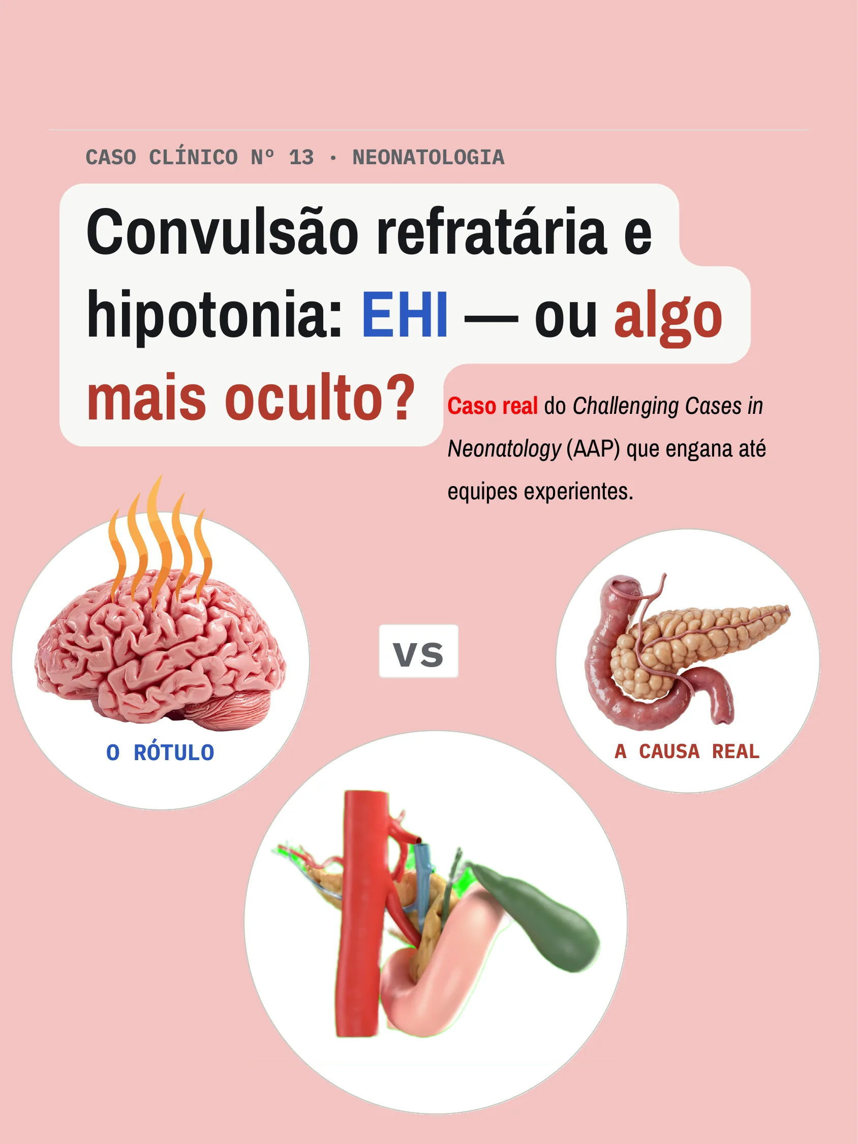 Capa do caso clínico de neonatologia comparando o rótulo inicial de lesão cerebral com a causa real pancreática, ilustrada por um cérebro, um pâncreas e vasos sanguíneos.