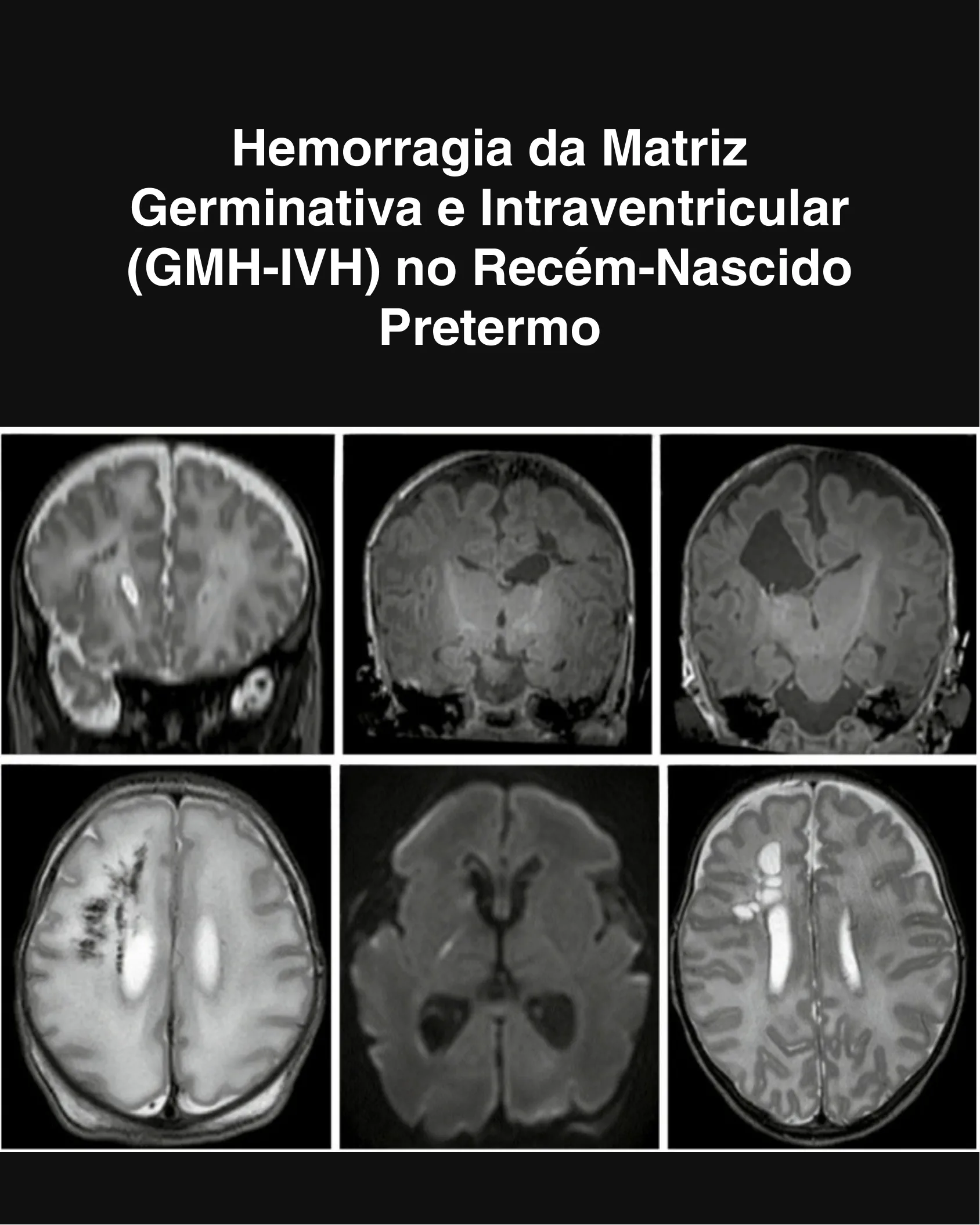 Capa do infográfico sobre Hemorragia da Matriz Germinativa e Intraventricular (GMH-IVH) no Recém-Nascido Pretermo com painel de imagens de ressonância magnética e ultrassom craniano.