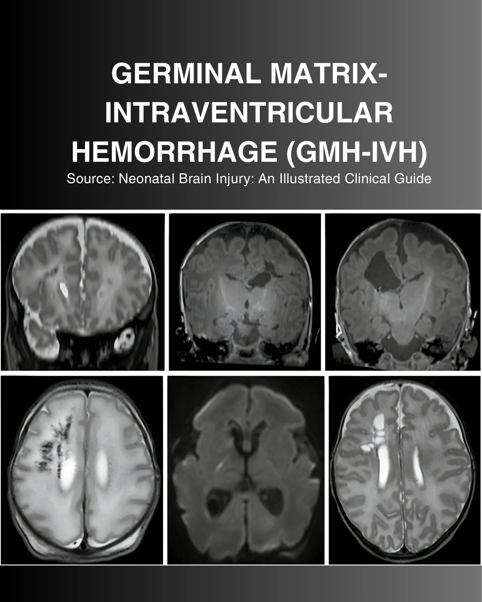 Cover page showing six neonatal brain MRI and ultrasound images with the title Germinal Matrix-Intraventricular Hemorrhage (GMH-IVH).
