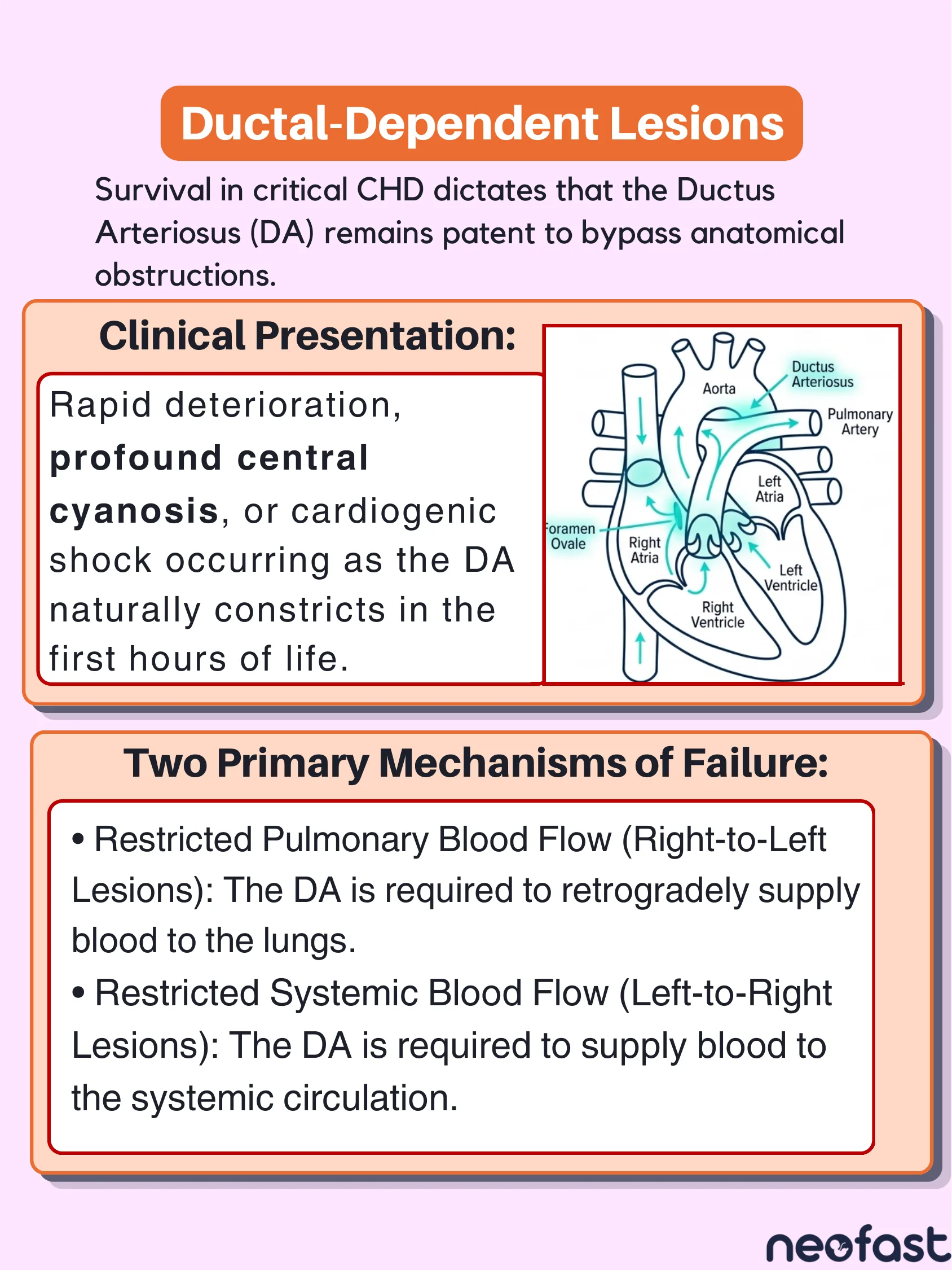 Diagram of neonatal heart circulation with ductus arteriosus, foramen ovale, aorta, pulmonary artery, and cardiac chambers labeled, alongside text on ductal-dependent lesion physiology