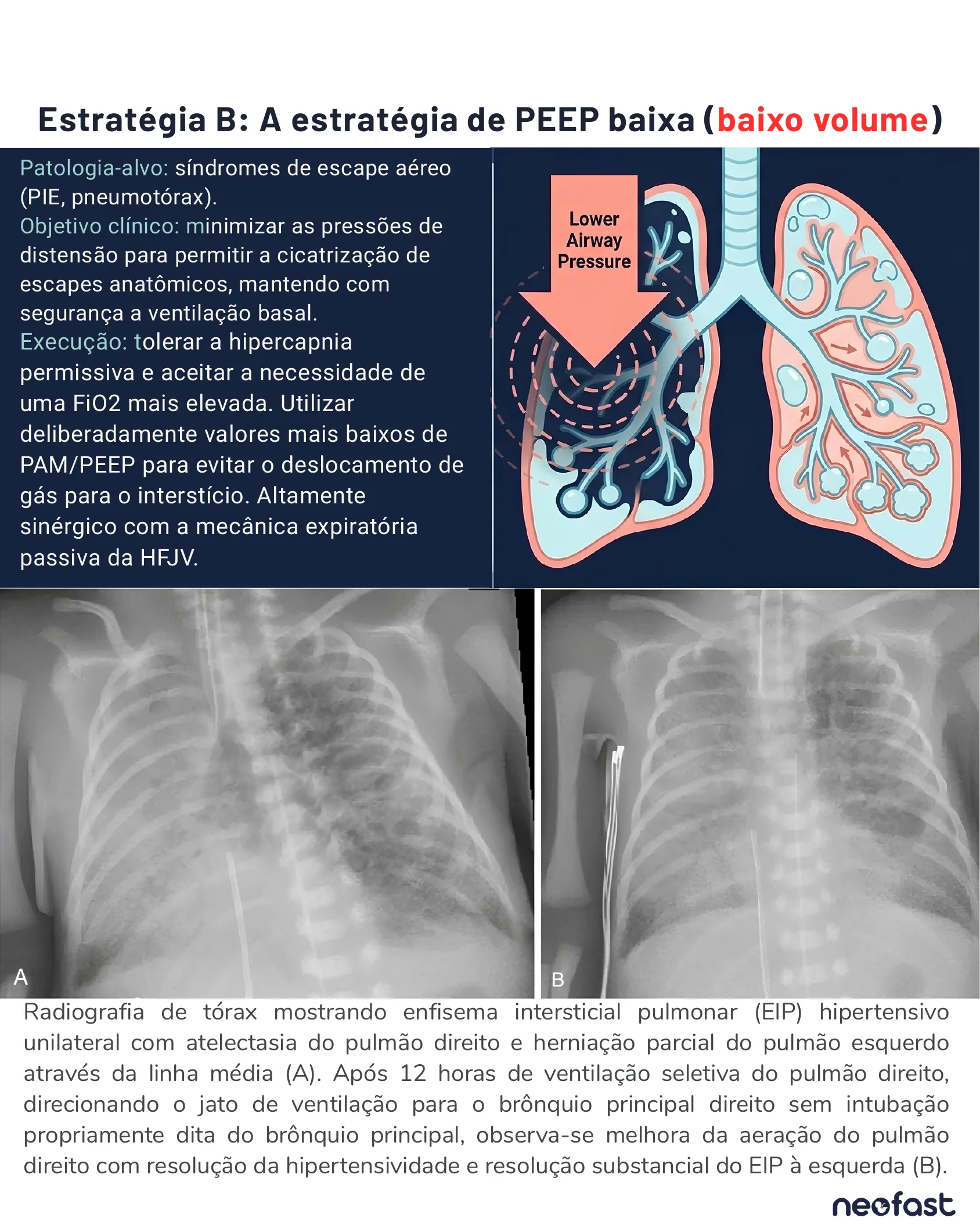 Ilustração pulmonar mostrando a redução da pressão de vias aéreas em áreas de escape de ar, acompanhada de radiografias de tórax evidenciando resolução do enfisema intersticial pulmonar após ventilação seletiva.