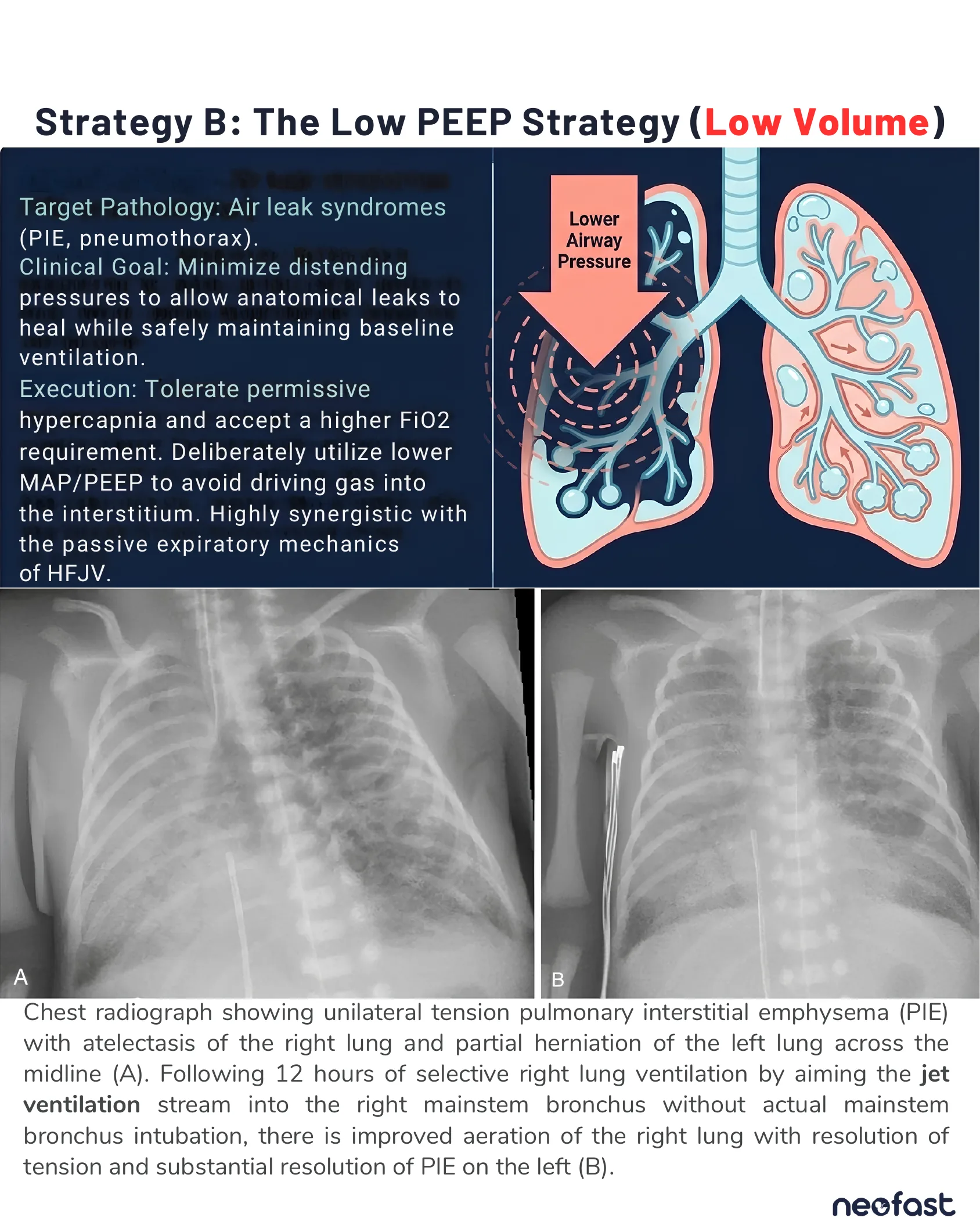 Illustration of a lung showing lower airway pressure applied to a leaking lung region, alongside chest radiographs demonstrating resolution of tension pulmonary interstitial emphysema after selective jet ventilation.