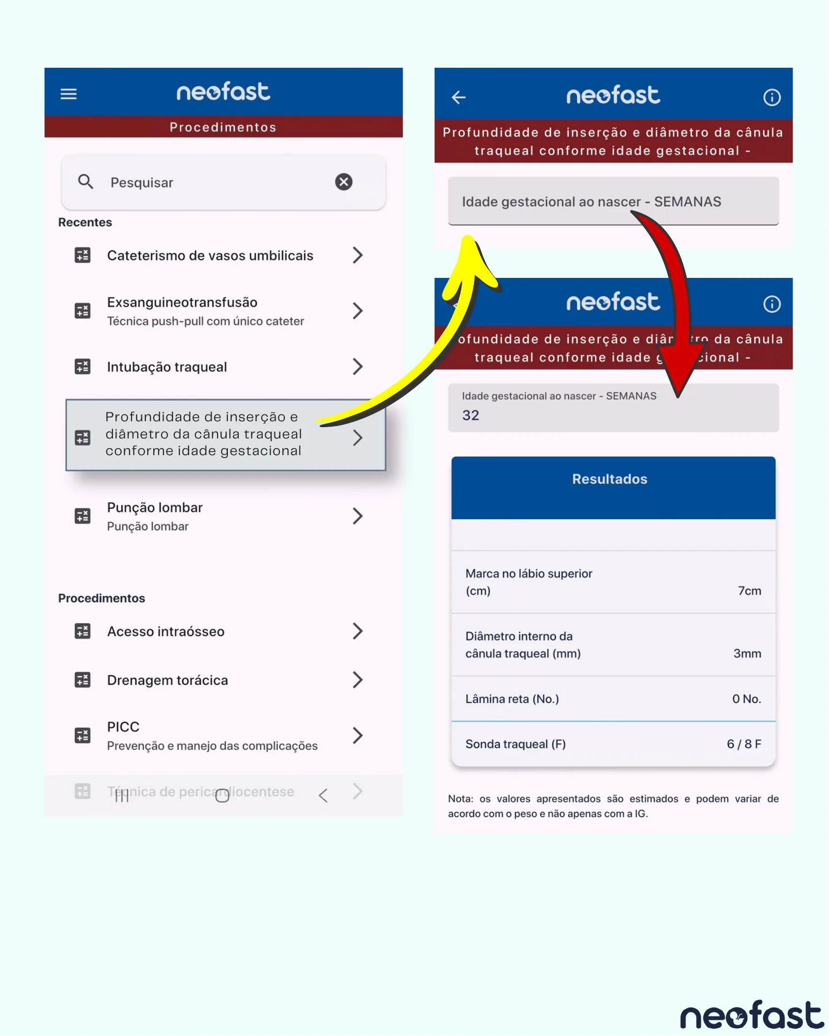 Capturas de tela do aplicativo Neofast mostrando a calculadora de profundidade de inserção e diâmetro da cânula traqueal conforme idade gestacional, com exemplo para 32 semanas.