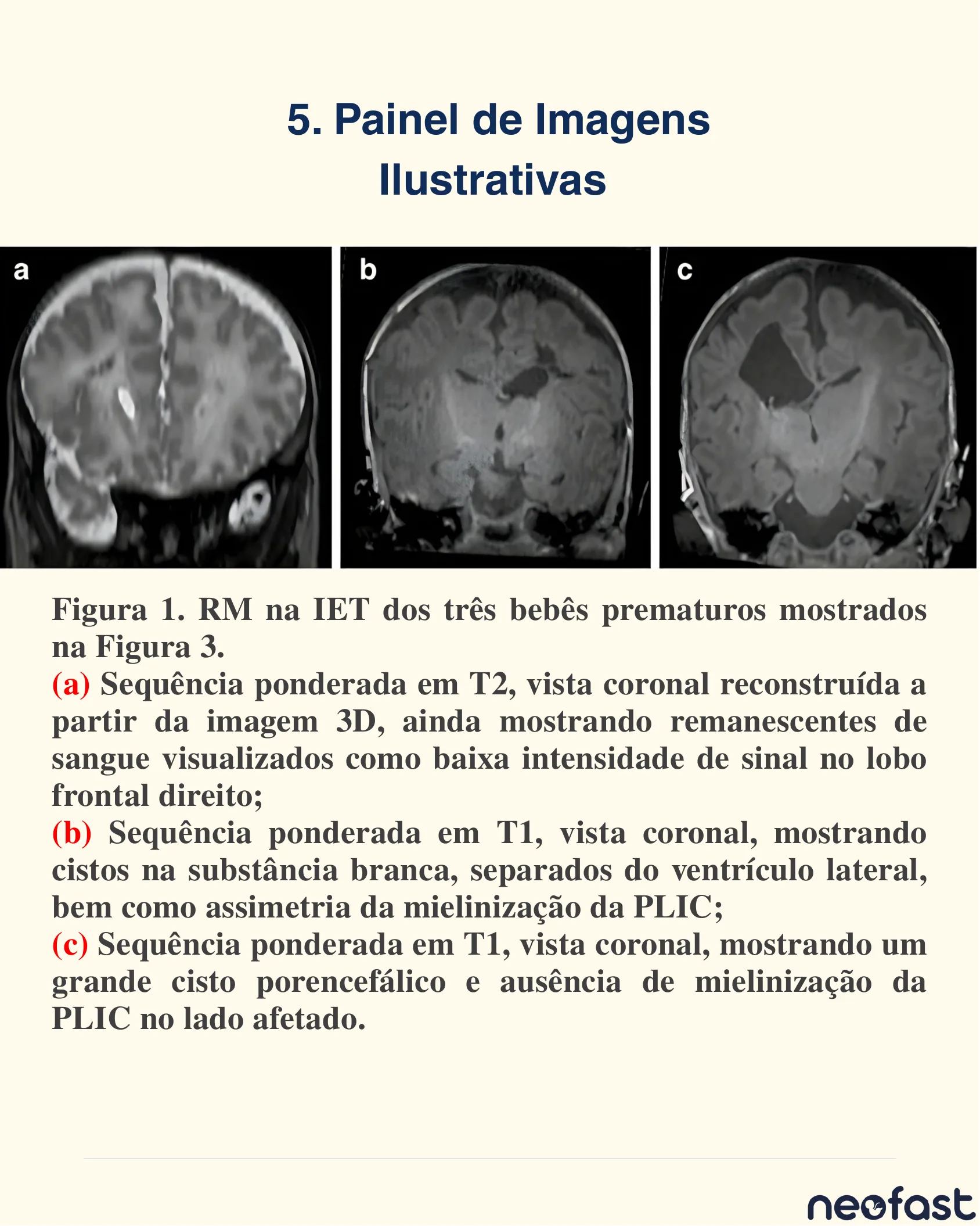Três imagens de ressonância magnética coronal na idade equivalente ao termo mostrando remanescentes de sangue, cistos na substância branca e cisto porencefálico com assimetria de mielinização.