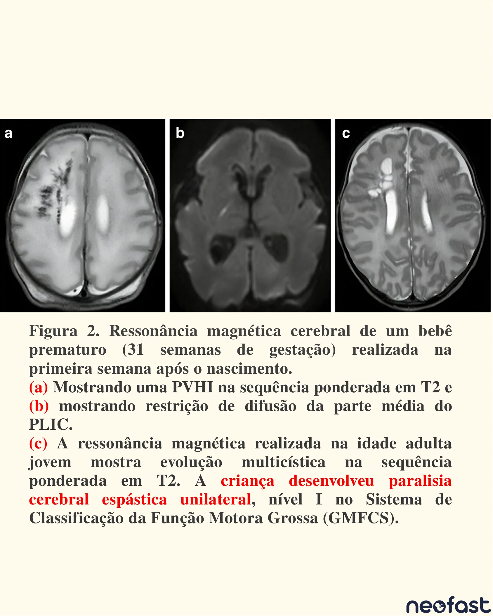 Sequência de ressonâncias magnéticas de um bebê prematuro de 31 semanas mostrando PVHI, restrição de difusão na PLIC e evolução multicística na idade adulta jovem com paralisia cerebral espástica.