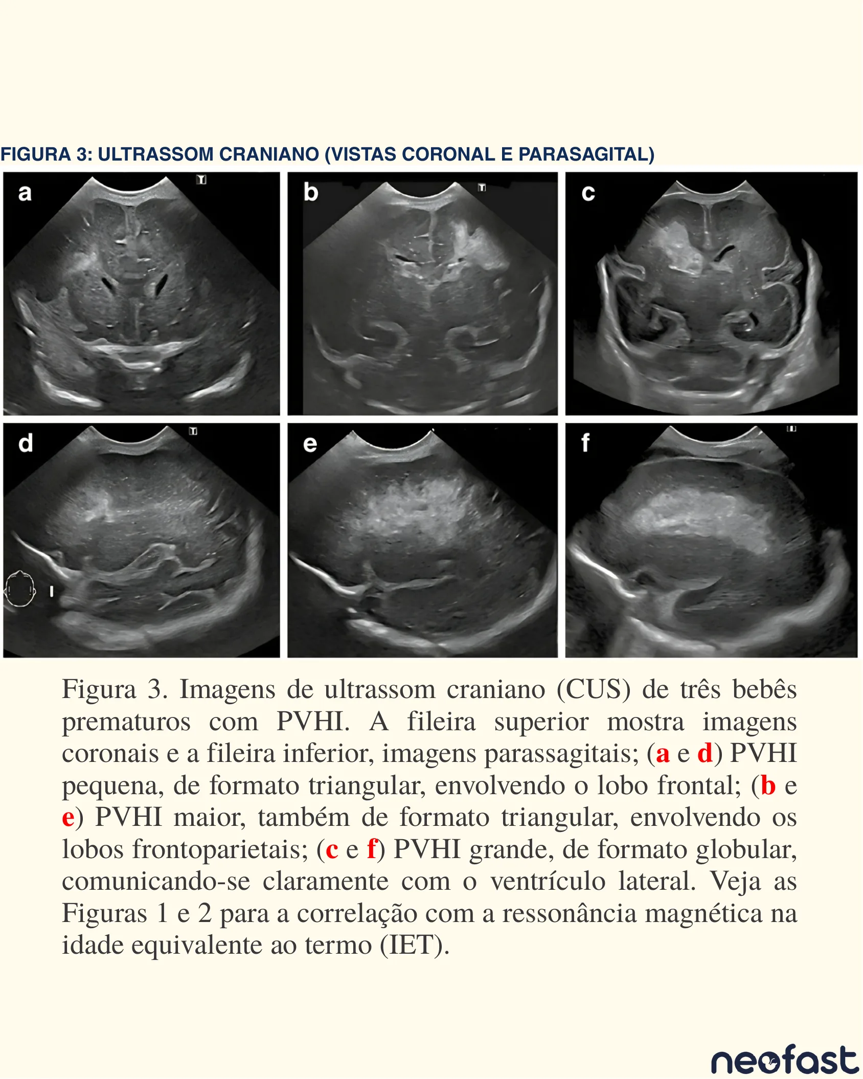 Painel de seis imagens de ultrassom craniano coronal e parassagital de três bebês prematuros com infarto hemorrágico periventricular (PVHI) de tamanhos variados.