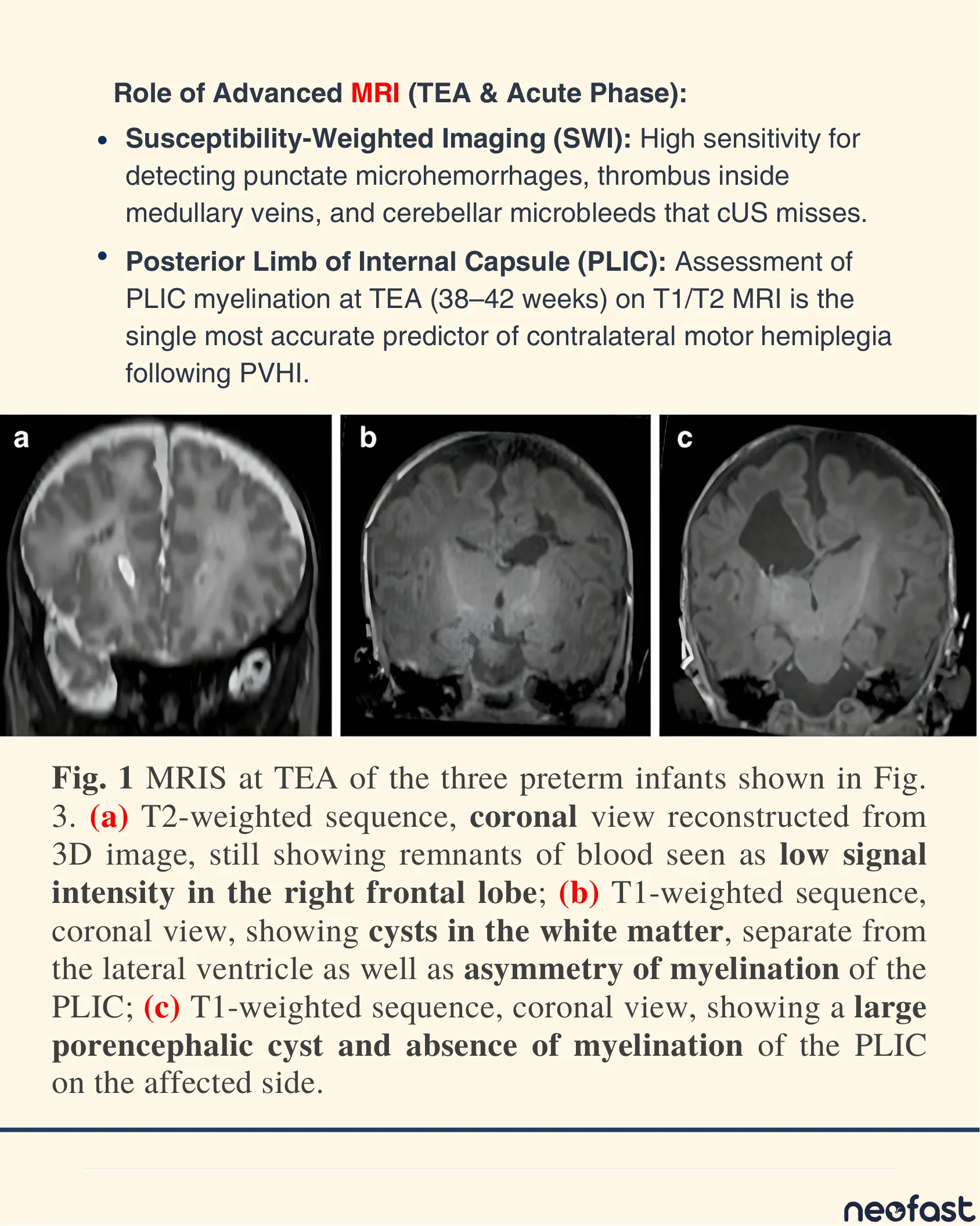 Three coronal MRI images at term-equivalent age of preterm infants showing blood remnants, white matter cysts, myelination asymmetry, and a porencephalic cyst.