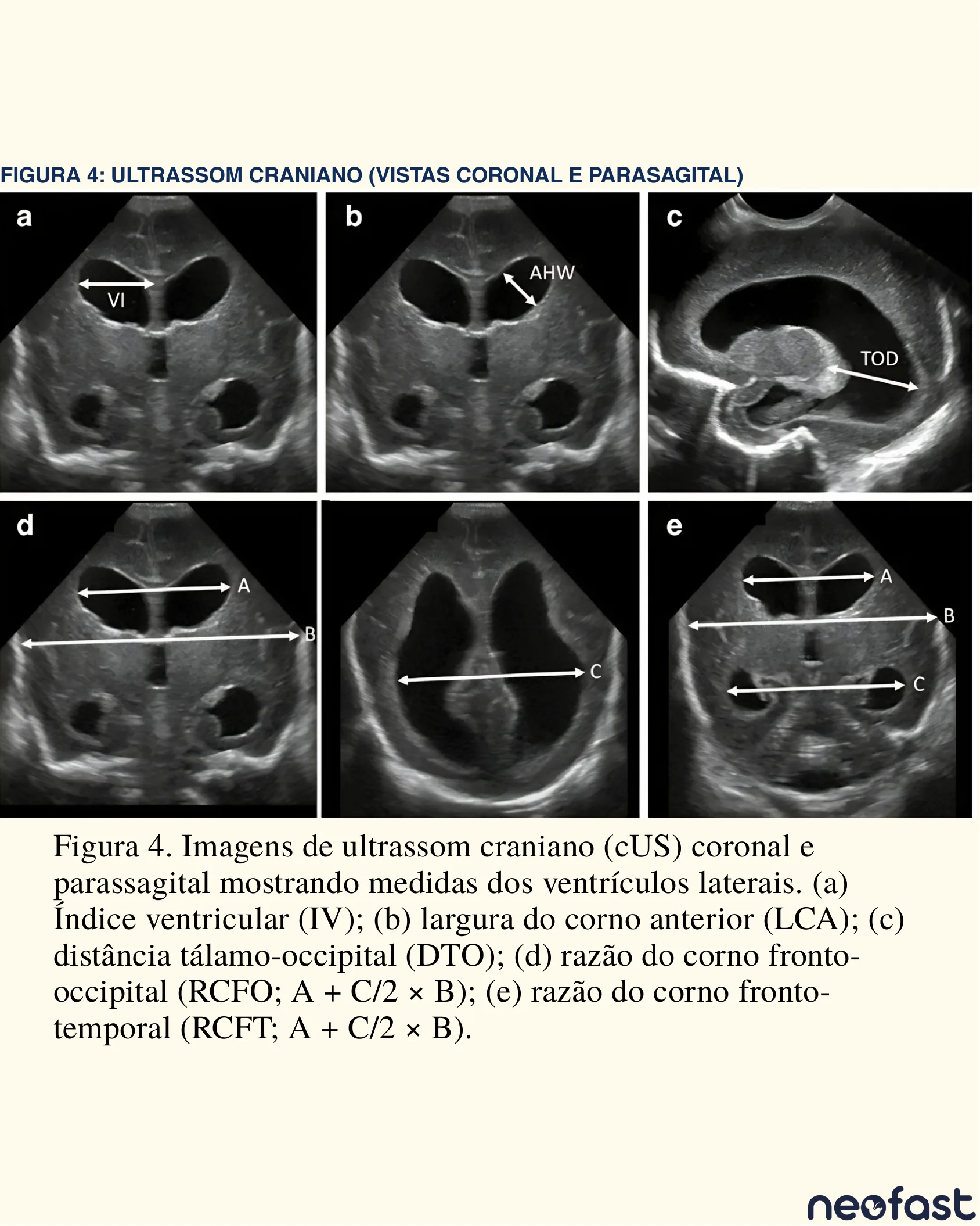 Painel com seis imagens de ultrassom craniano coronal e parassagital ilustrando as medidas dos ventrículos laterais: índice ventricular, largura do corno anterior, distância tálamo-occipital e razões do corno fronto-occipital e fronto-temporal.