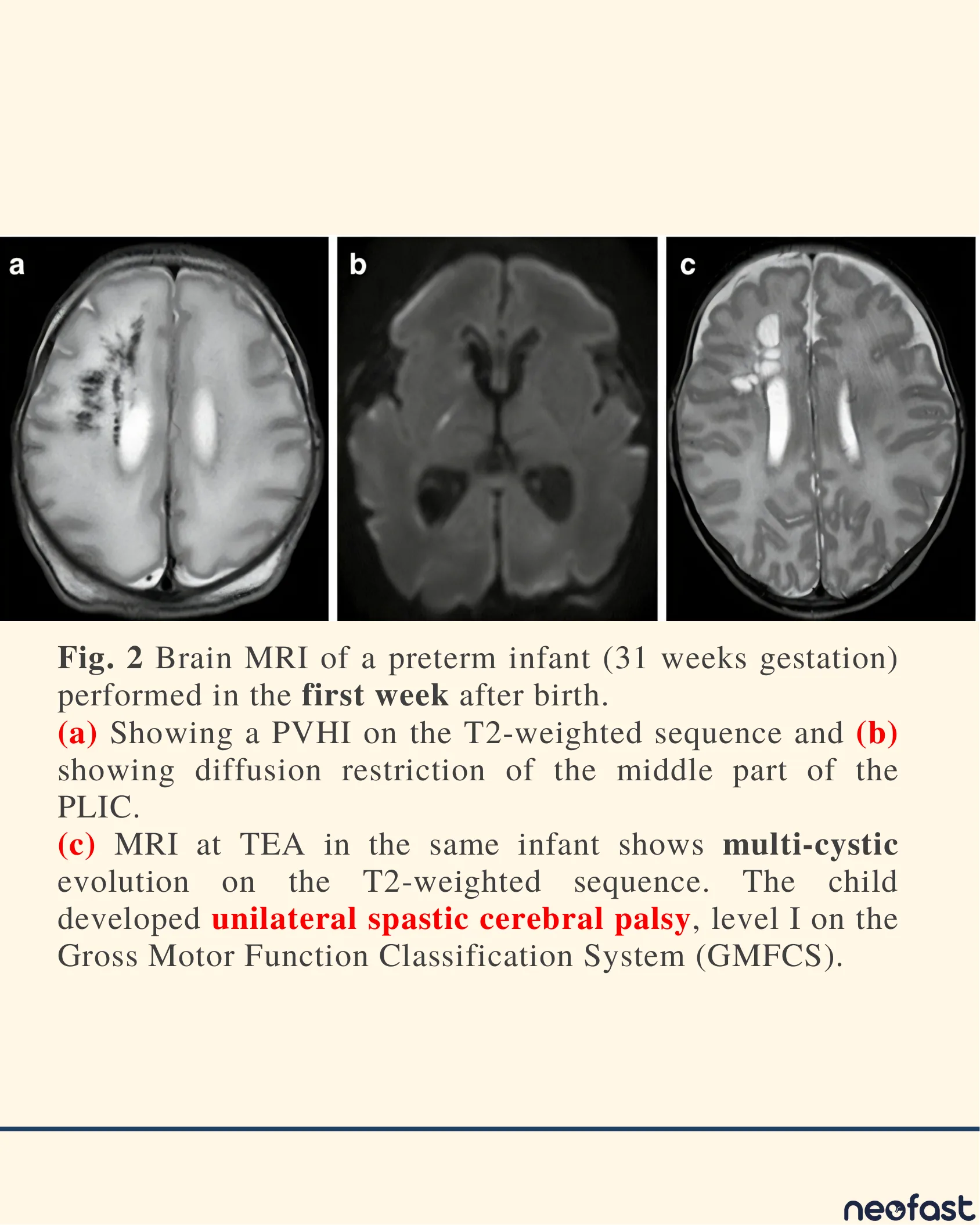 Three axial brain MRI panels of a 31-week preterm infant showing periventricular hemorrhagic infarction on T2 and diffusion sequences in the first week, and multi-cystic evolution at term-equivalent age.