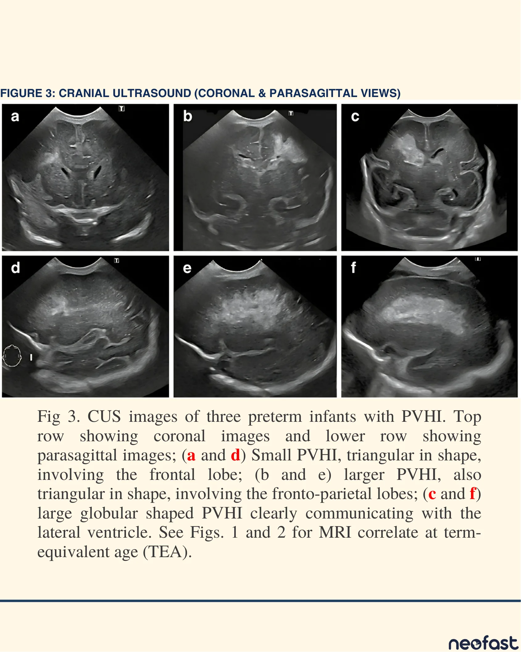 Six cranial ultrasound panels in coronal and parasagittal views showing three preterm infants with periventricular hemorrhagic infarction of varying size and shape.