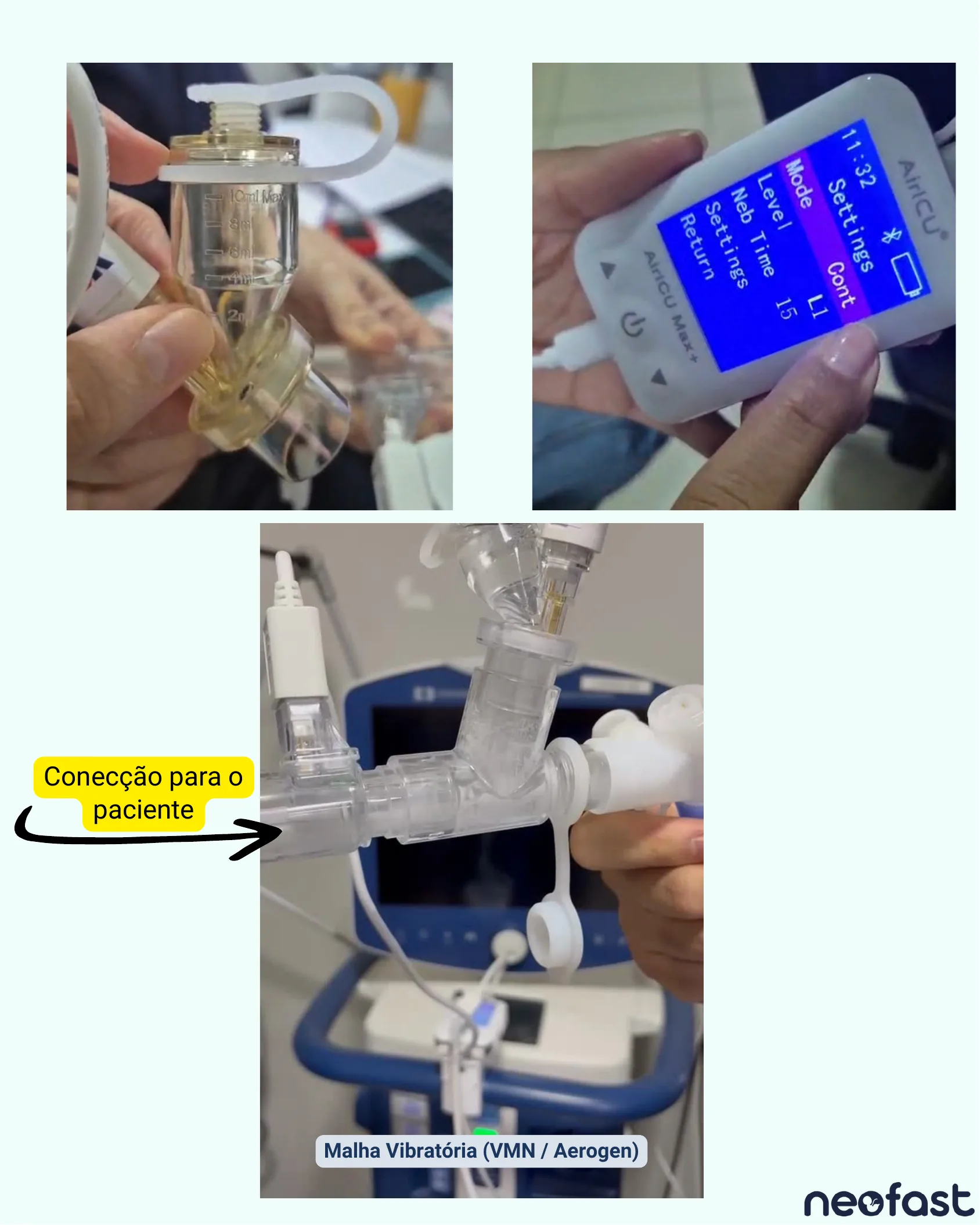 Fotografias mostrando a montagem de um nebulizador de malha vibratória Aerogen com o dispositivo AiroCU Max+ e sua conexão no circuito de ventilação próxima ao paciente.