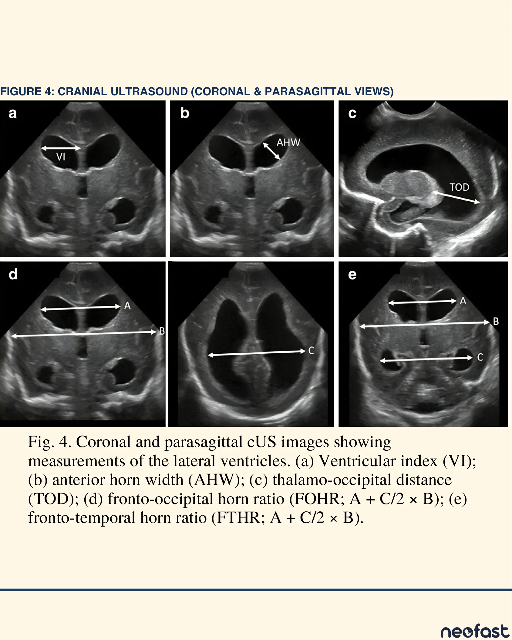 Five cranial ultrasound panels illustrating the measurement techniques for ventricular index, anterior horn width, thalamo-occipital distance, fronto-occipital horn ratio, and fronto-temporal horn ratio.